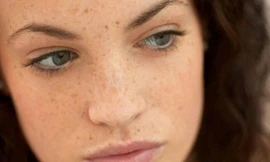 Tàn nhang là vết sạm nhỏ ngoài da. Hình minh họa.