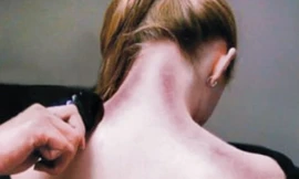 Cạo gió như thế nào cho đúng?