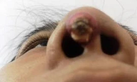 Miếng độn silicon bị đâm thủng mũi người phụ nữ. Ảnh: Phú Mỹ