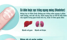 Thay đổi bất thường trên móng tay cảnh báo bệnh