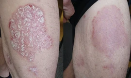 Hình ảnh trước và sau 8 tuần sử dụng sản phẩm thảo dược Dr Michaels Soratinex cho bệnh vảy nến.