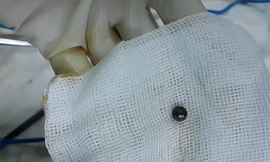 Viên bi xe đạp đã được lấy ra Ảnh: Bệnh viện Nhân dân 115 cung cấp