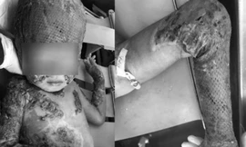 Bệnh nhi sau khi được ghép da từ người cha