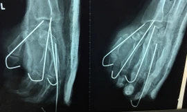 Ảnh chụp X-quang sau mổ của bệnh nhân. Ảnh bệnh viện cung cấp.