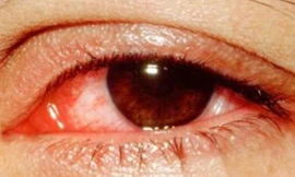 Những biến chứng đáng sợ của đau mắt đỏ