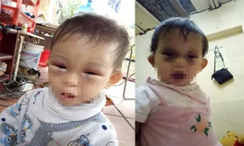 Cháu Thuỳ T. bị thâm tím hai bên mắt. (Ảnh: Gia đình cung cấp)