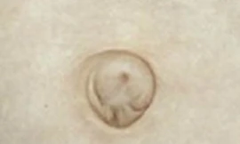 Nhìn hình dạng rốn chẩn đoán bệnh