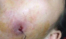 Trào lưu phẫu thuật tạo má lúm có thể khiến khuôn mặt bị hủy hoại