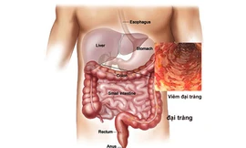 5 dấu hiệu giúp tự nhận biết sớm ung thư đại trực tràng