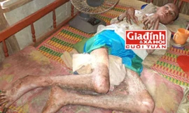 Anh Sang với căn bệnh lạ khiến cơ thể “hóa rắn” khủng khiếp. Ảnh TG