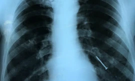 Hình ảnh X-quang cây đinh nằm ở phế quản bệnh nhân. Ảnh: V.T.