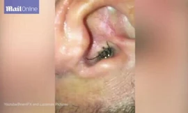 Phát hoảng với con rết dài 10 cm trong tai