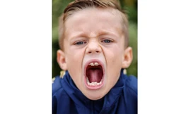 Cậu bé Zak Brown sở hữu đến 4 hàm răng 