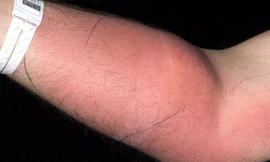 Cánh tay người đàn ông sưng đỏ vì tiêm tinh trùng trong 18 tháng