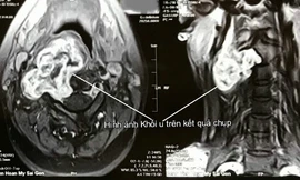 Hình ảnh khối u trên MRI.