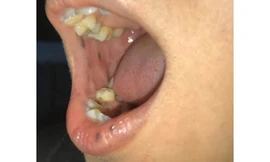 Nổi đốm sậm màu trên mặt, một phụ nữ Bến Tre mắc bệnh cực hiếm 