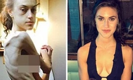 Emelle đã kịp nhận ra tình trạng gầy trơ xương và có biện pháp phục hồi. Ảnh: Daily Mail.