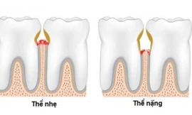 Những biến chứng nguy hiểm của bệnh viêm lợi