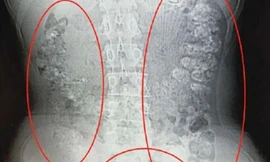 Cô bé chứa hàng trăm hạt trân châu chưa tiêu hóa trong bụng 