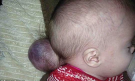 Bé Faith Martin với phần não nằm ngoài hộp sọ. Ảnh: Daily Mail