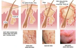 Cơ chế của mụn trứng cá.
