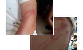 Thương tích trên người cháu P..