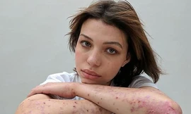 10 cô gái dũng cảm và câu chuyện vết sẹo đi theo cả cuộc đời