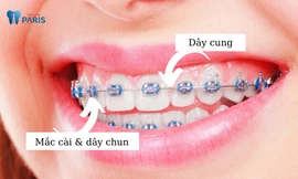 Niềng răng mắc cài kim loại thường