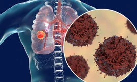 Tỷ lệ mắc u phổi đang ngày một tăng nhanh