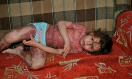 Sofia Ezhova bỏng nặng sau khi làm theo lời hướng dẫn "trở thành nàng tiên" của trò chơi trên mạng - Ảnh: The Sun