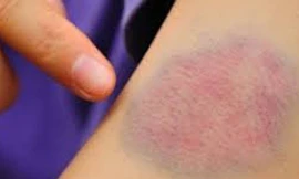 Bệnh nhận bị rối loạn đông máu thường xuất huyết các vệt bầm tím. Ảnh: Sức khỏe đời sống.