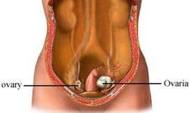 Minh họa so sánh buồng trứng bị ung thư (phải) và buồng trứng lànhẢnh: uvahealth.com