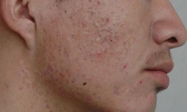 Điều trị mụn trứng cá cần liệu trình lâu dài.