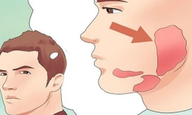 Cha đốt rạ chữa quai bị, con biến chứng viêm màng não