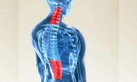 Thoái hóa cột sống thường gặp ở đốt sống cổ và thắt lưng.
