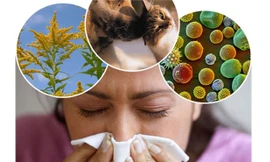 5 mẹo tự chữa dị ứng hiệu quả tại nhà