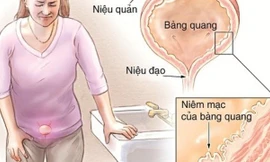 12 bài thuốc hỗ trợ điều trị viêm bàng quang cực hiệu quả