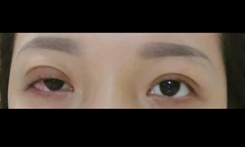 Cơ mí mắt cô gái bị liệt sau thủ thuật thẩm mỹ. Ảnh: Nhân vật cung cấp.