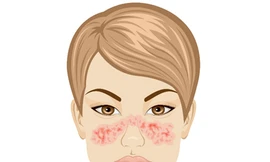 Vết phát ban hình con bướm cảnh báo nguy cơ mắc bệnh lupus. Ảnh: Pinterest.