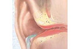 Viêm tai do đi bơi gia tăng khi hè về.