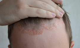 Triệu chứng vảy nến da đầu