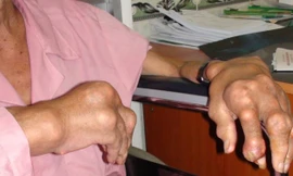 Tinh thể urat thường lắng đọng tại khớp bàn tay, cổ tay,…