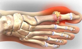 Những đồ ăn làm giảm cơn đau của người bệnh gút