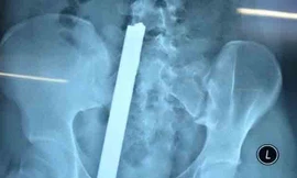 Hình ảnh thanh sắt đâm xuyên người thiếu nữ 16 tuổi