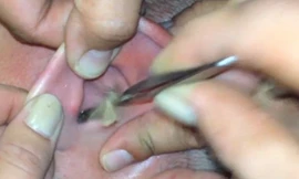 Con sâu bướm còn sống được lấy ra từ tai Mikey. Ảnh: Newsrt.