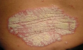 Mảng đỏ với vẩy trắng phủ lên ở bệnh nhân vẩy nến