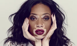 Hội chứng khiến người bệnh sở hữu vẻ ngoài kỳ dị có 1 không 2