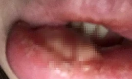 Môi bị sưng phồng sau khi tiêm botox của Sally. Ảnh: Daily Mail.