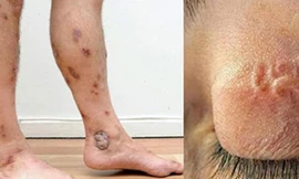 Có nguy cơ bị giun, sán, viêm loét tay chân do vệ sinh không sạch