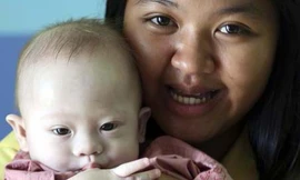 Trong bức ảnh chụp ngày 3/8/2014, sản phụ người Thái là Pattaramon Chanbua, 21 tuổi, chụp cùng với Gammy – cậu bé 9 tháng tuổi sinh ra bị hội chứng Đao tại bệnh viện Sri Racha, tỉnh Chonburi, miền nam Thái Lan. Cặp vợ chồng nhờ Chanbua mang thai hộ đã man